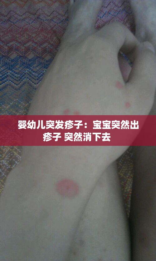 婴幼儿突发疹子：宝宝突然出疹子 突然消下去 